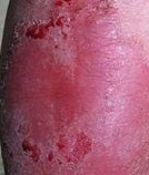 ��Ƥ����м����֢״