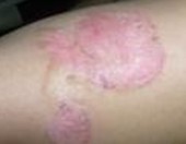 ţƤѢ��ͨ��ѪҺ��Ⱦ��