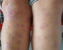 ţƤѢ�����ڵ�֢״