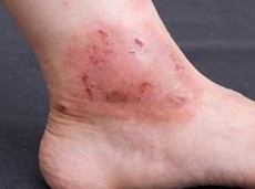 夏季湿疹的危害