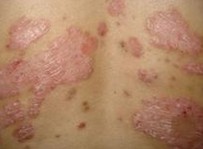 寻常型牛皮癣有哪些症状