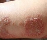 �ֲ�ʪ��֢״