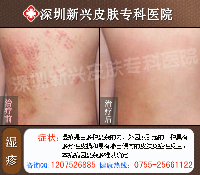 深圳新兴医院湿疹康复前后对比